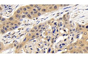 Detection of CASP7 in Human Lung cancer Tissue using Polyclonal Antibody to Caspase 7 (CASP7)