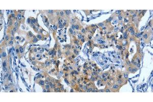 Immunohistochemistry of paraffin-embedded Human lung cancer tissue using MUC15 Polyclonal Antibody at dilution 1:50 (MUC15 anticorps)