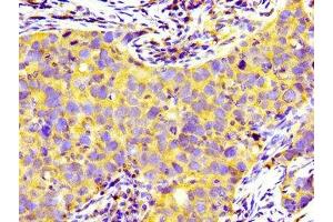Immunohistochemistry of paraffin-embedded human pancreatic cancer using ABIN7158932 at dilution of 1:100 (PRNP anticorps  (AA 23-64))