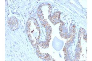 Formalin-fixed, paraffin-embedded human Prostate Carcinoma stained with PMEPA1 Mouse Monoclonal Antibody (PMEPA1/2697).