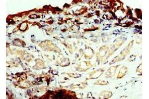 Immunohistochemistry of paraffin-embedded human breast cancer using ABIN7143737 at dilution of 1:100 (FUT6 anticorps  (AA 170-359))