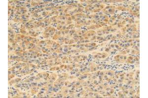 IHC-P analysis of Human Liver Cancer Tissue, with DAB staining. (MGP anticorps  (AA 1-103))