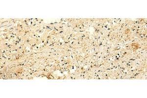 Immunohistochemistry of paraffin-embedded Human prost ate cancer tissue using GLYATL2 Polyclonal Antibody at dilution of 1:50(x200)