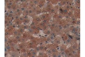 Detection of COL1a1 in Human Liver cancer Tissue using Polyclonal Antibody to Collagen Type I Alpha 1 (COL1a1)