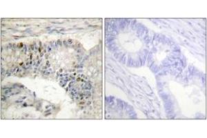 Immunohistochemistry analysis of paraffin-embedded human colon carcinoma tissue, using Histone H1 (Ab-17) Antibody. (Histone H1 anticorps  (AA 1-50))