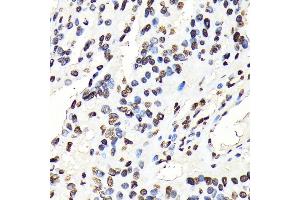 Immunohistochemistry of paraffin-embedded human oophoroma using Phospho-STA-Y694 antibody (ABIN6135328, ABIN6136272, ABIN6136273 and ABIN7101887) at dilution of 1:100 (40x lens). (STAT5A anticorps  (pTyr694))