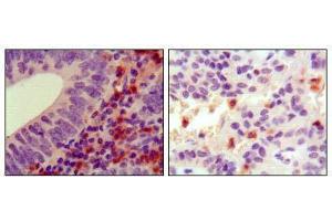 Immunohistochemical analysis of paraffin-embedded human colon cancer (left) and ancreas cancer (right), showing cytoplasmic localization using HCK mouse mAb with DAB staining. (HCK anticorps)