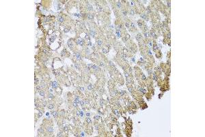 Immunohistochemistry of paraffin-embedded human liver injury using SET antibody at dilution of 1:100 (x40 lens).