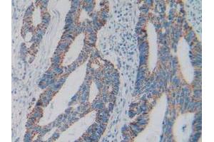 IHC-P analysis of Human Rectum Cancer Tissue, with DAB staining. (C1QBP anticorps  (AA 76-282))