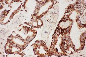 Anti-CNTF Picoband antibody,  IHC(P): Human Lung Cancer Tissue