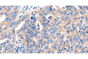 Immunohistochemistry of paraffin-embedded Human ovarian cancer tissue using KLK2 Polyclonal Antibody at dilution 1:100 (Kallikrein 2 anticorps)