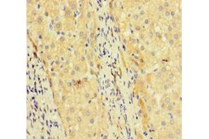 Immunohistochemistry of paraffin-embedded human liver cancer using ABIN7172463 at dilution of 1:100 (TCF4 anticorps  (AA 419-525))