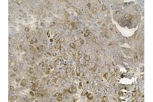 ABIN6257921 and ABIN6274885 at 1/100 staining human melanoma by IHC-P.