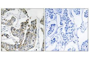 Immunohistochemistry analysis of paraffin-embedded human breast carcinoma tissue using BLK (Phospho-Tyr501) antibody. (BLK anticorps  (pTyr501))