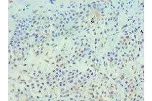 Immunohistochemistry of paraffin-embedded human breast cancer using ABIN7173326 at dilution of 1:100 (TFF1 anticorps  (AA 25-84))