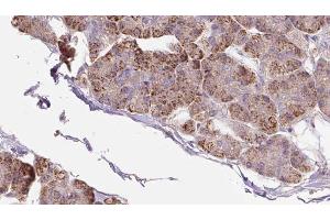 ABIN6273285 at 1/100 staining Human pancreas cancer tissue by IHC-P.