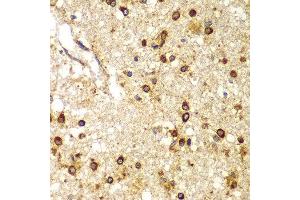 Immunohistochemistry of paraffin-embedded human brain cancer using SMAD9 antibody at dilution of 1:100 (x400 lens). (SMAD9 anticorps)