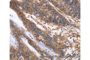 Immunohistochemistry of Human colon cancer using ITGB1 Polyclonal Antibody at dilution of 1:60 (ITGB1 anticorps)