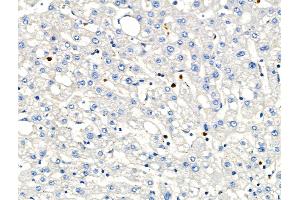 ABIN6263158 and ABIN6266586 at 1/100 staining Human liver cancer and adjacent normal tissues by IHC-P.