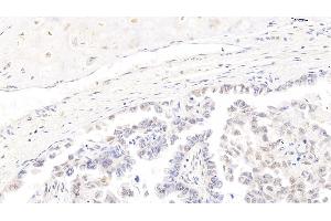 Detection of CDK4 in Human Lung cancer Tissue using Polyclonal Antibody to Cyclin Dependent Kinase 4 (CDK4)