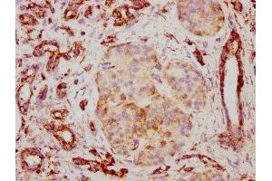 IHC image of ABIN7127858 diluted at 1:117 and staining in paraffin-embedded human pancreatic cancer performed on a Leica BondTM system.