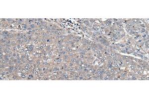 Immunohistochemistry of paraffin-embedded Human liver cancer tissue using ARL1 Polyclonal Antibody at dilution of 1:50(x200) (ARL1 anticorps)