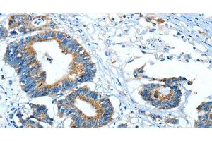 Immunohistochemistry of paraffin-embedded Human colon cancer using GLRA1 Polyclonal Antibody at dilution of 1:30 (GLRA1 anticorps)