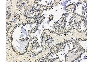 GAB3 Antibody at 1/100 staining human ovarian cancer by IHC-P. (GAB3 anticorps)