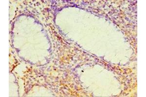 Immunohistochemistry of paraffin-embedded human colon cancer using ABIN7164384 at dilution of 1:100 (DHX58 anticorps  (AA 389-678))