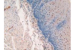 IHC-P analysis of Human Esophagus Cancer Tissue, with DAB staining. (SP100 anticorps  (AA 610-802))
