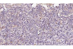 ABIN6273171 at 1/100 staining Human lymph cancer tissue by IHC-P. (STT3B anticorps  (C-Term))
