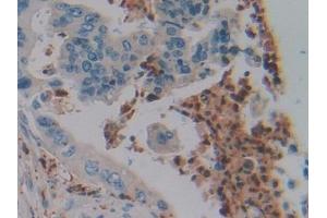 Detection of DEFa4 in Human Colorectal cancer Tissue using Polyclonal Antibody to Defensin Alpha 4, Corticostatin (DEFa4)