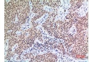 Immunohistochemistry (IHC) analysis of paraffin-embedded Human Mammary Cancer, antibody was diluted at 1:100. (P57 (Ser24) anticorps)