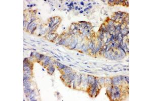 IHC-P: HIF-1-alpha antibody testing of human intestinal cancer tissue