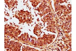 IHC image of ABIN7146274 diluted at 1:400 and staining in paraffin-embedded human cervical cancer performed on a Leica BondTM system.