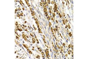 Immunohistochemistry of paraffin-embedded human stomach cancer using TACR3 antibody. (TACR3 anticorps  (AA 356-465))
