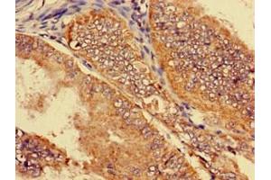 Immunohistochemistry of paraffin-embedded human endometrial cancer using ABIN7170144 at dilution of 1:100