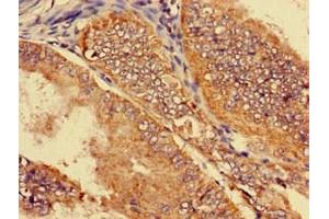 Immunohistochemistry of paraffin-embedded human endometrial cancer using ABIN7170144 at dilution of 1:100 (SLC22A2 anticorps  (AA 48-135))