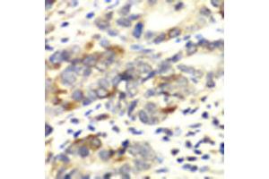 Immunohistochemistry of paraffin-embedded human colon carcinoma using APLP1 antibody at dilution of 1:100 (x40 lens).