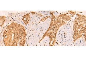 Immunohistochemistry of paraffin-embedded Human esophagus cancer tissue using SETD1A Polyclonal Antibody at dilution of 1:25(x200) (SETD1A anticorps)