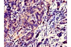 Immunohistochemistry of paraffin-embedded human pancreatic cancer using ABIN7170444 at dilution of 1:100 (C21ORF56 anticorps  (AA 1-186))