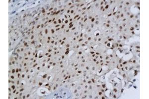 Formalin-fixed and paraffin embedded human bladder cancer labeled with Anti-DBC1/DELETED IN BLADDER CANCER 1 Polyclonal Antibody, Unconjugated (ABIN680308) followed by conjugation to the secondary antibody and DAB staining