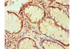 Immunohistochemical of paraffin-embedded human colon cancer using ABIN7176818 at dilution of 1:200. (PLA2G7 anticorps)