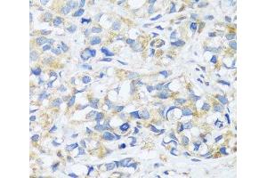 Immunohistochemistry of paraffin-embedded Human breast cancer using BRK1 Polyclonal Antibody at dilution of 1:100 (40x lens). (BRK1 anticorps)