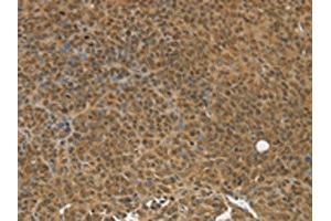 The image on the left is immunohistochemistry of paraffin-embedded Human ovarian cancer tissue using ABIN7192784(TGM7 Antibody) at dilution 1/30, on the right is treated with synthetic peptide. (Transglutaminase 7 anticorps)