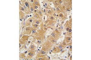 Formalin-fixed and paraffin-embedded human hepatocarcinoma tissue reacted with OA5 antibody (N-term) 7412a , which was peroxidase-conjugated to the secondary antibody, followed by DAB staining. (APOA5 anticorps  (N-Term))