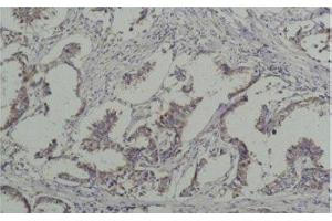 Immunohistochemistry of paraffin-embedded Human breast carcinoma tissue with Phosphotyrosine Monoclonal Antibody at dilution of 1:200 (Phosphotyrosine anticorps)