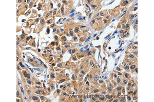 Immunohistochemistry of Human lung cancer using DUSP8 Polyclonal Antibody at dilution of 1:40 (DUSP8 anticorps)