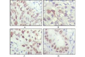 Immunohistochemical analysis of paraffin-embedded human lung carcinoma (A), liver carcinoma (B), breast carcinoma (C) and kiney carcinoma (D), showing nuclear localization with DAB staining using CHK2 mouse mAb. (CHEK2 anticorps)