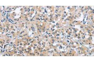 Immunohistochemistry of paraffin-embedded Human thyroid cancer tissue using TRDMT1 Polyclonal Antibody at dilution 1:40 (Dnmt2 anticorps)